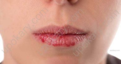 Chapped lips