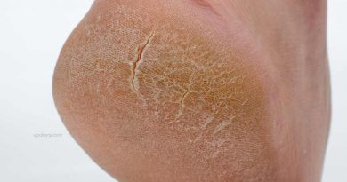Cracked heel