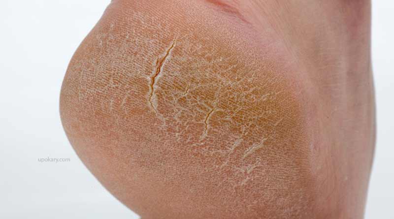 Cracked heel