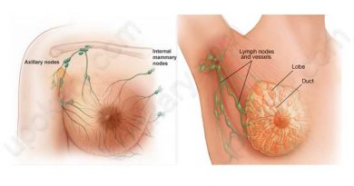 breast cancer