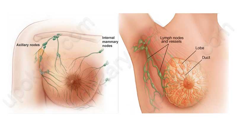 breast cancer
