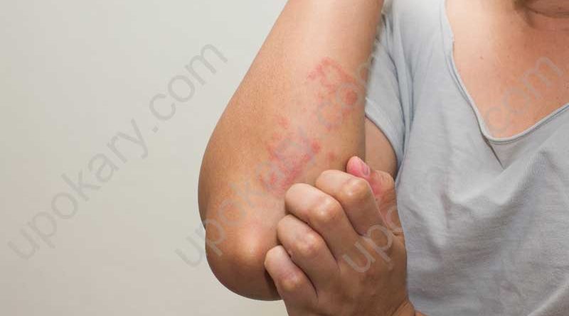 Allergy
