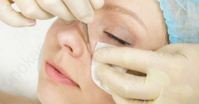 blackheads