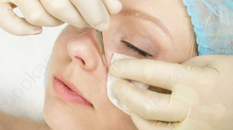 blackheads