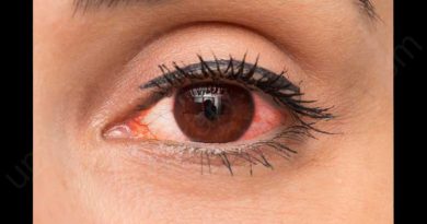 red eye