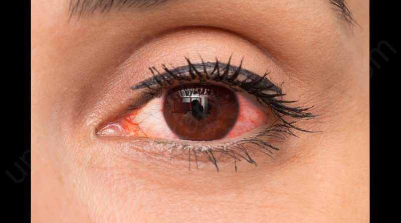 red eye