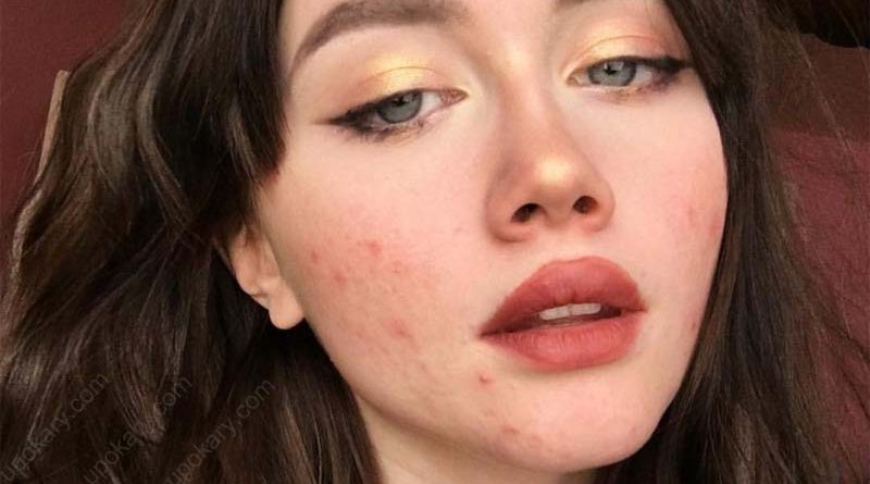 acne on face