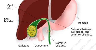 gallstone