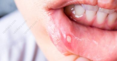 mouth sore