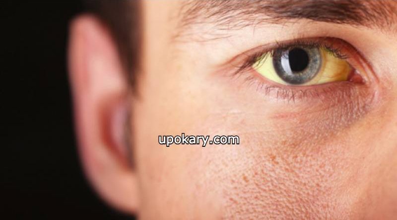Jaundice