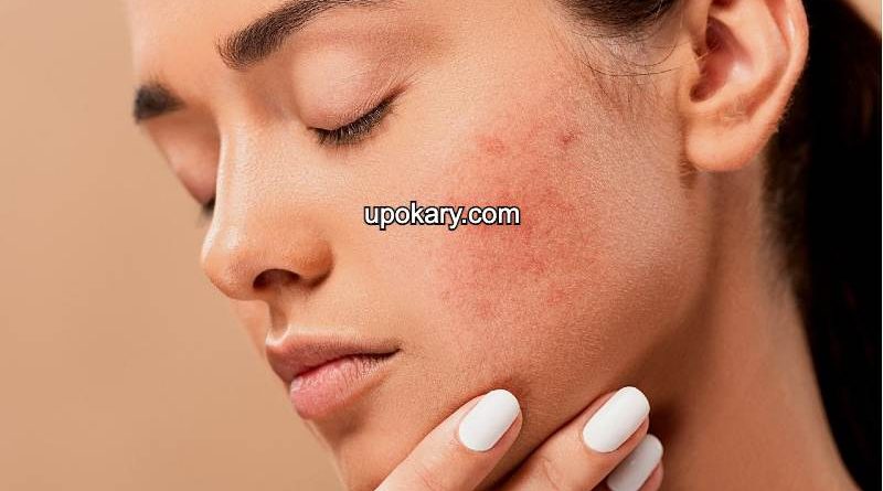 Food casue acne