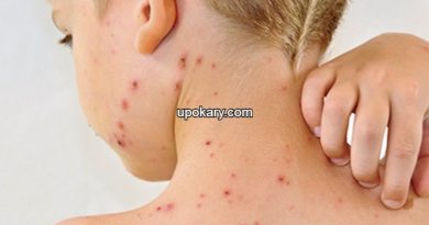 Chicken pox