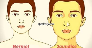 Jaundice