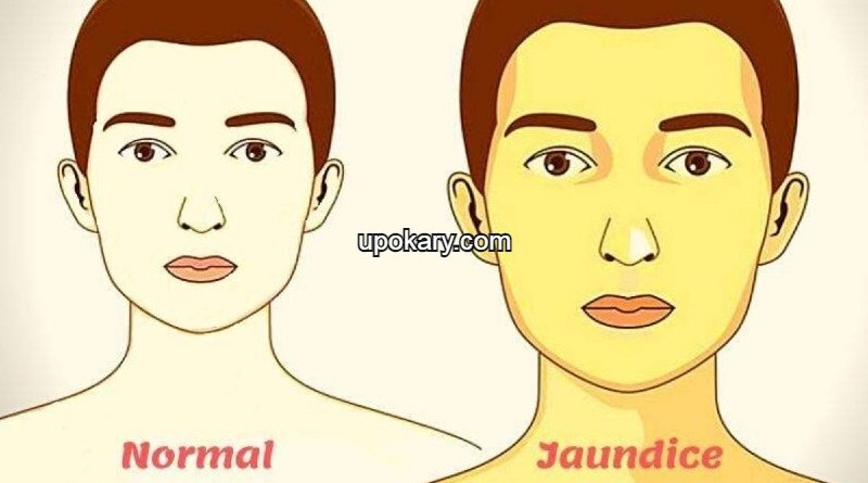 Jaundice
