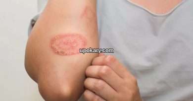 Ringworm