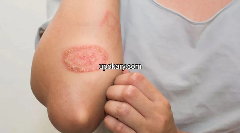 Ringworm