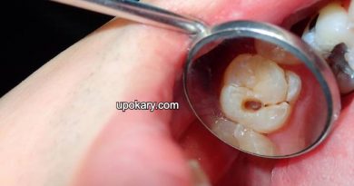 cavity teeth