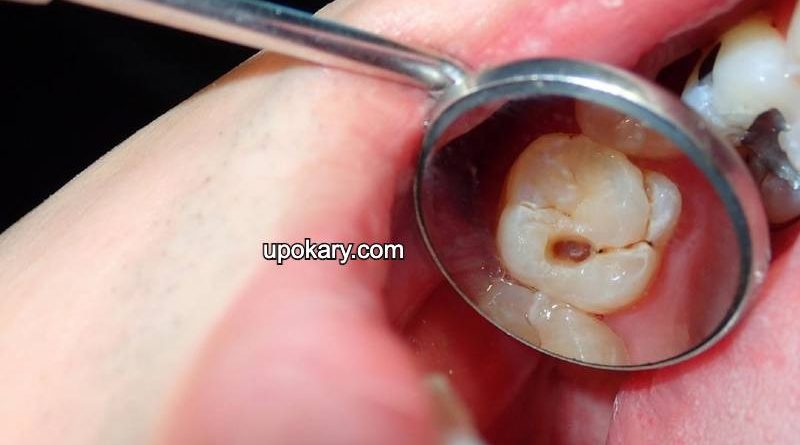cavity teeth