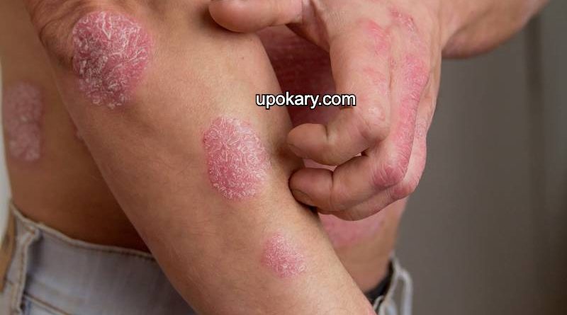 eczema