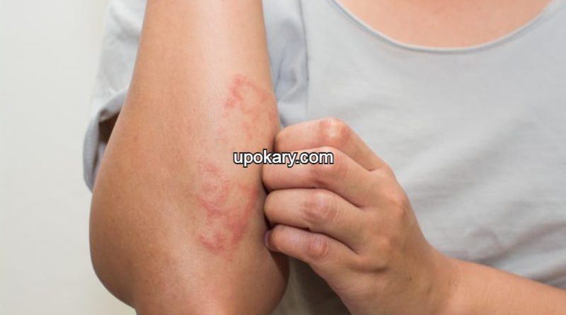 skinrash