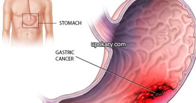 stomach cancer