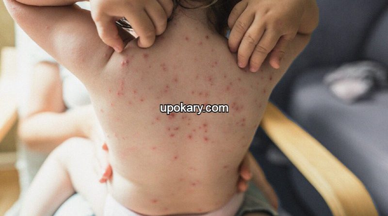 pox