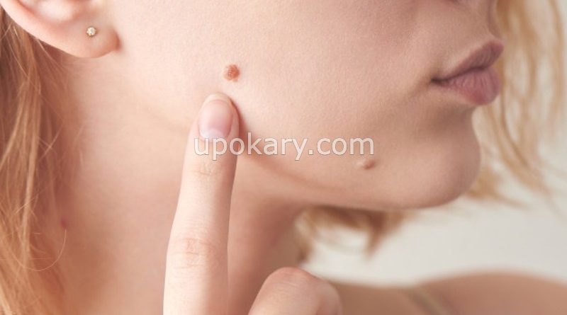 face mole