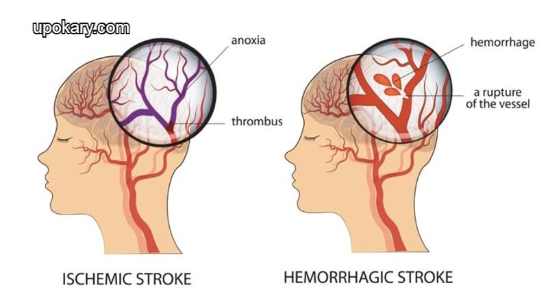 haemorrhagic