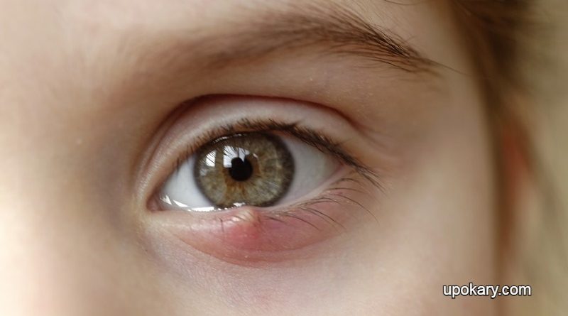 stye