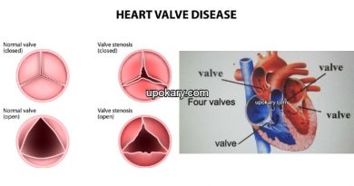 valve