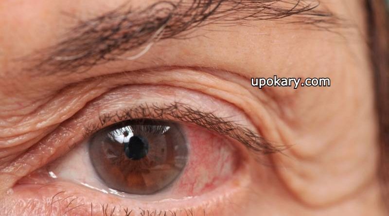 Glaucoma