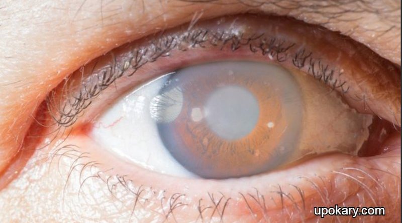 What is glaucoma