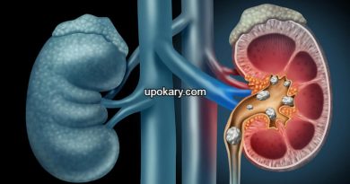 kidney stone