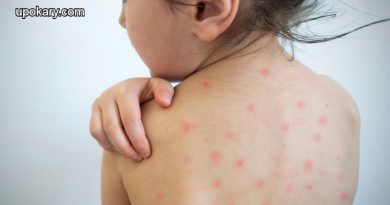 measles