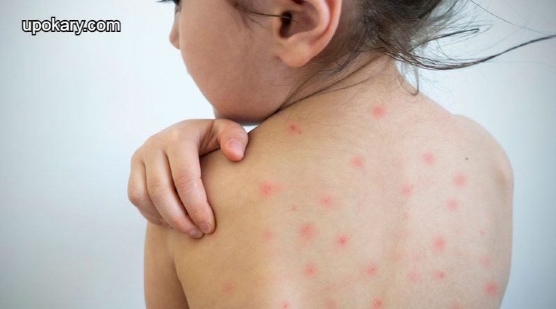 measles