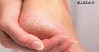 Cracked Skin