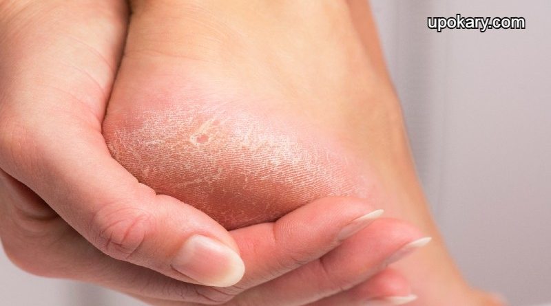 Cracked Skin