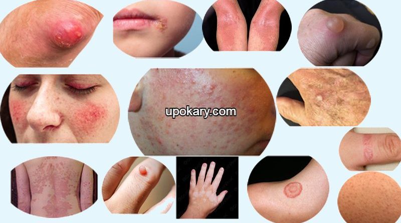 Skin-Disorder