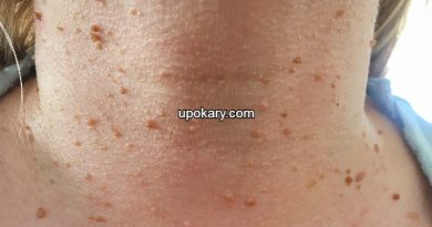Skin-tags