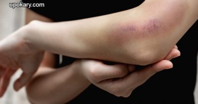 bruising