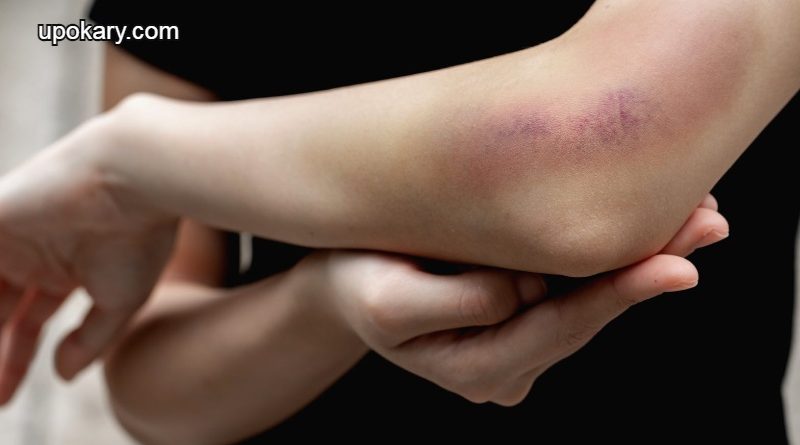 bruising