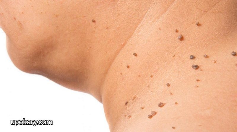 skin_tags