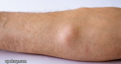 Lipoma