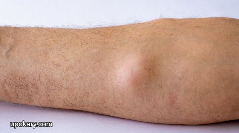 Lipoma