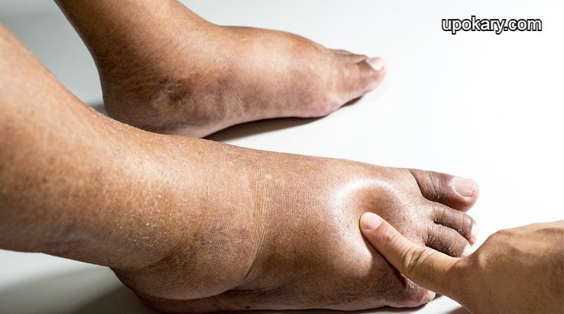 edema_pitches