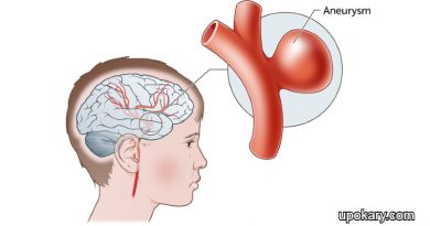 Brain_aneurysm