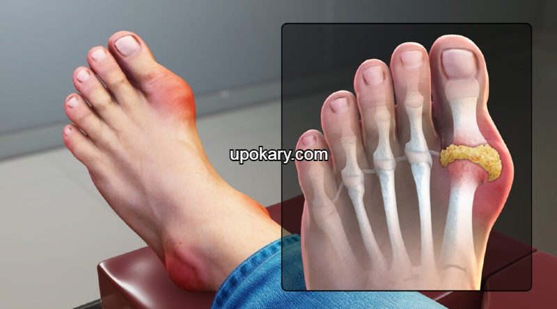 Gout_Signs
