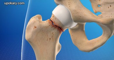 Hip fracture