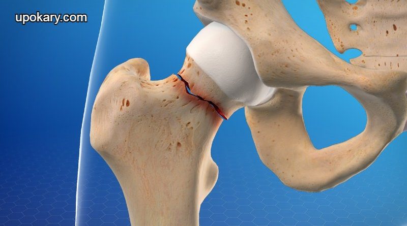 Hip fracture