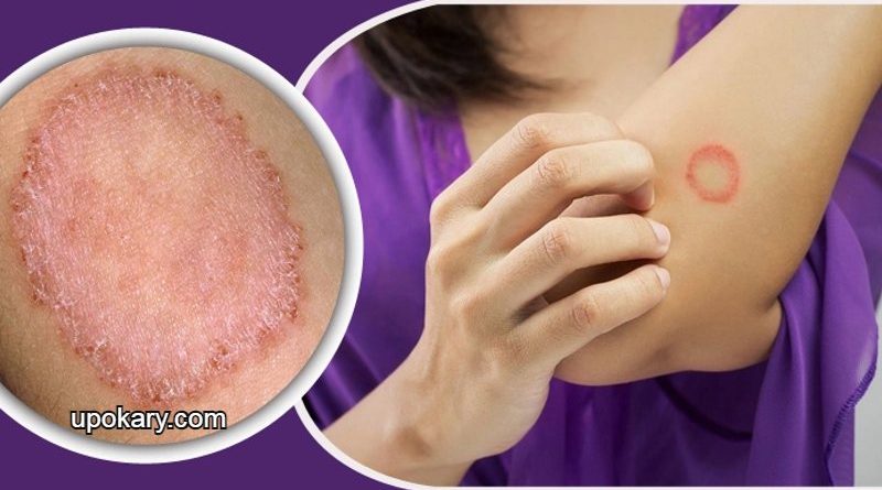 ringworm